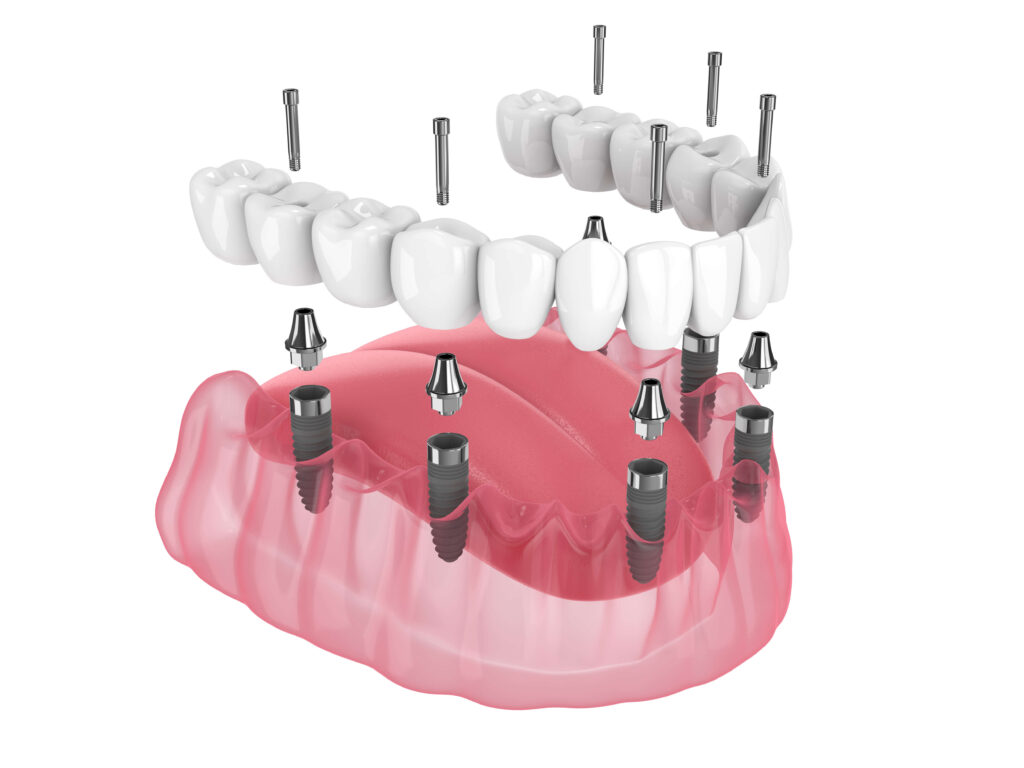 The Best Dental Implant Marketing Company. New Tab Marketing